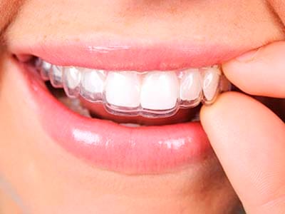 APARELHO DENTAL ESTÉTICO 