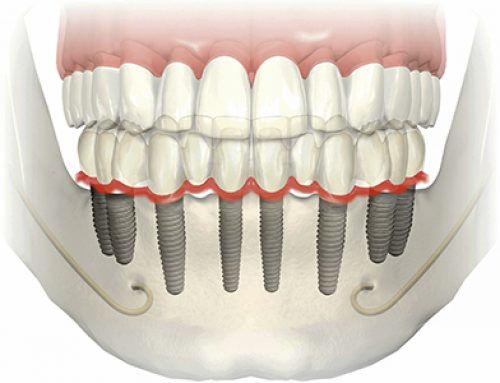 IMPLANTES DENTÁRIOS