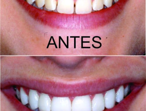 Lentes de Contato ou Facetas de Porcelana para Dentes